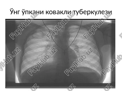 o'pkani kovakli tuberkulezi — PPTX