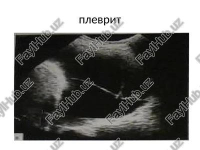 plevrit — PPTX