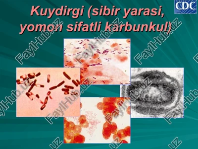 kuydirgi (sibir yarasi, yomon sifatli karbunkul) — PPT