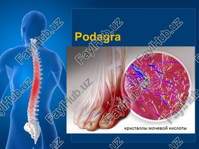 podagra — PPTX