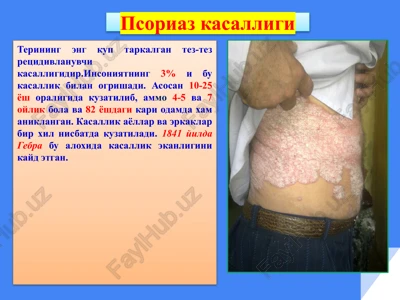 psoriaz kasalligi — PPTX