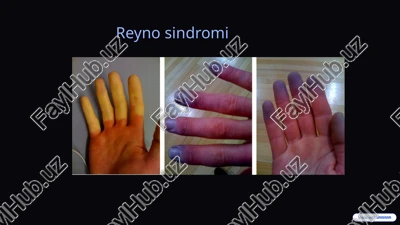 reyno sindromi — PPTX