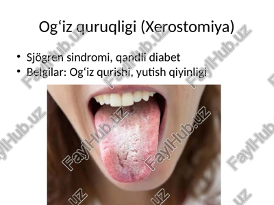 og‘iz quruqligi (xerostomiya) — PPTX
