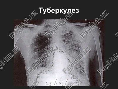 tuberkulez — PPTX