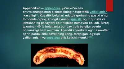 appenditsit — PPTX