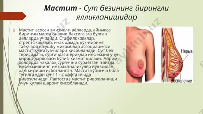 мастит - сут безининг йирингли яллиғланишидир — PPTX