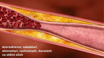 ateroskleroz - sabablari, alomatlari, tashxislash, davolash va oldini olish — PPTX