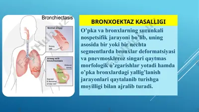 bronxoektaz kasalligi — PPTX