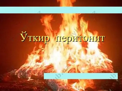 ўткир перитонит — PPT