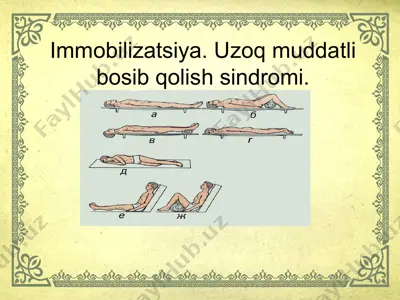 immobilizatsiya. uzoq muddatli bosib qolish sindromi — ZIP