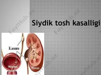 siydik tosh kasalligi — PPTX