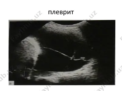 плеврит — PPTX