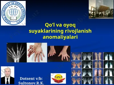 qo‘l va oyoq suyaklarining rivojlanish anomaliyalari — PPTX