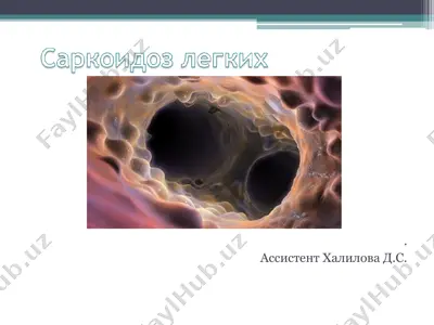 саркоидоз легких (болезнь бенье-бека-шауманна) — PPT