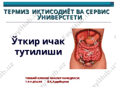 ichak tutilishi (ileus) — PPT