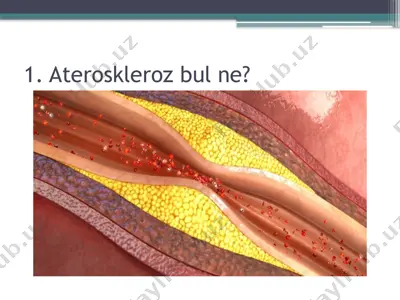 ateroskleroz haqida ma'lumot — PPTX