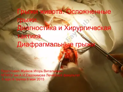 грыжи живота. осложненные грыжи. — PPT