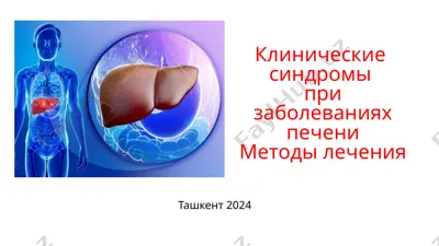 клинические синдромы при заболеваниях печени. методы лечения — PPTX