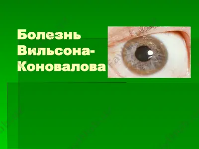 болезнь вильсона-коновалова — PPTX