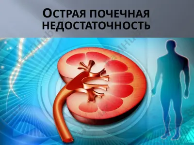 острая почечная недостаточность — PPTX