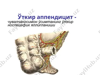 ўткир аппендицит - чувалчангсимон ўсимтанинг ўткир носпецефик яллиғланиши — PPT
