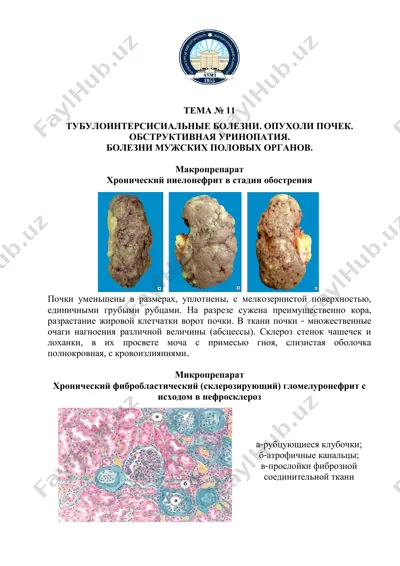 хронический пиелонефрит в стадии обострения — PDF