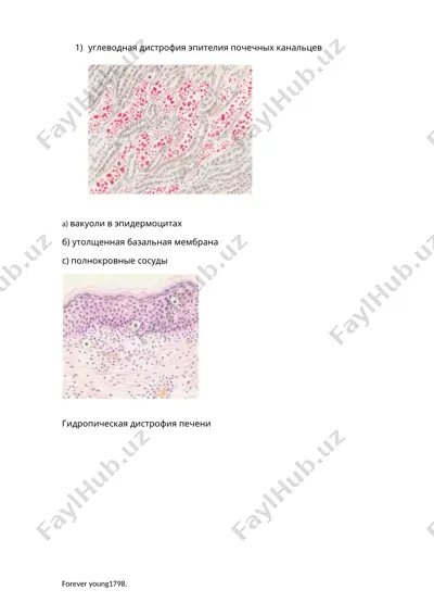 жировая дистрофия эпителия почечных канальцев — DOCX