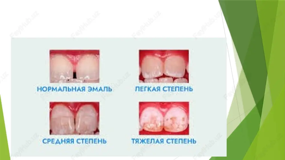 manbalariga almashtirish tishlarning flyuorozga uchrashini ancha kamaytiradi. giperplaziya.emalning haddan tashqari ko’p hosil bo’lishi, 1,5% aholida uchraydi.emal tomchilari tishning bo’yin qismida joylashgan bo’lib,milkning shilliq qavati bilan berkitilgan bo’ladi.o’lchami 4dan 5mmgacha bo’ladi.markazda kesma o’tkazilganda dentin aniqlanadi,ba’zan faqat emaldan tashkil topgan bo’lishi mumkin. irsiyat bilan bog’liq bo’lgan tish qattiq to’qimasining kasalliklari.tugallanmagan amelogenez,stenton-kapdepon sindromi,tugallanmagan dentinogenez,mramor kasalligi kiradi. tugallanmagan amelogenez(amelogenesis imperfecta)-emalning rivojlanishini buzilishi bilan kechuvchi kasallik.chuprinina bo’yicha 4 ta klinik shaklga ega: 1-formasida uncha katta bo’lmagan son va sifatiy o’zgarishlar kuzatiladi.tishlar normal shakl va o’lchamda, emal silliq,yaltiroq,lekin sariq yoki jigarrang.mikroskopik dentin-emal chegarasida notekislik aniqlanadi,organic moddaning sonini ortishi kuzatiladi. 2-formasida o’zgarishlar yaqqol namoyon bo’ladi.tishlar o’z vaqtida chiqadi,toj qismi dastlab normal boladi.1-3 yil o’tib emal matoviy,keyin och jigarrang tusga kiradi,keyin g’adir-budir bo’lib, yorilisglar paydo bo’ladi,emal keyinchalik qisman yoki to’liq yo’qoladi.dentin zich,och jigarrang yoki jigarrang ko’rinishda bo’ladi. 3-formasida tish o’z vaqtida chiqadi,normal o’lchamga ega bo’ladi.emal oq rangda bo’lib, unda ko’plab egatchalar bo’ladi.hamma tishlarda emal tez yo’qolib ketadi,dentin ochilib …
