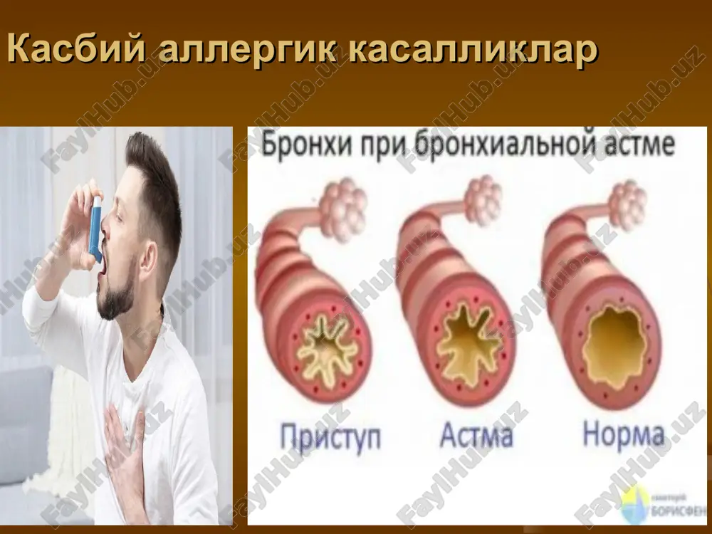 kasbiy allergik kasalliklar — PPT