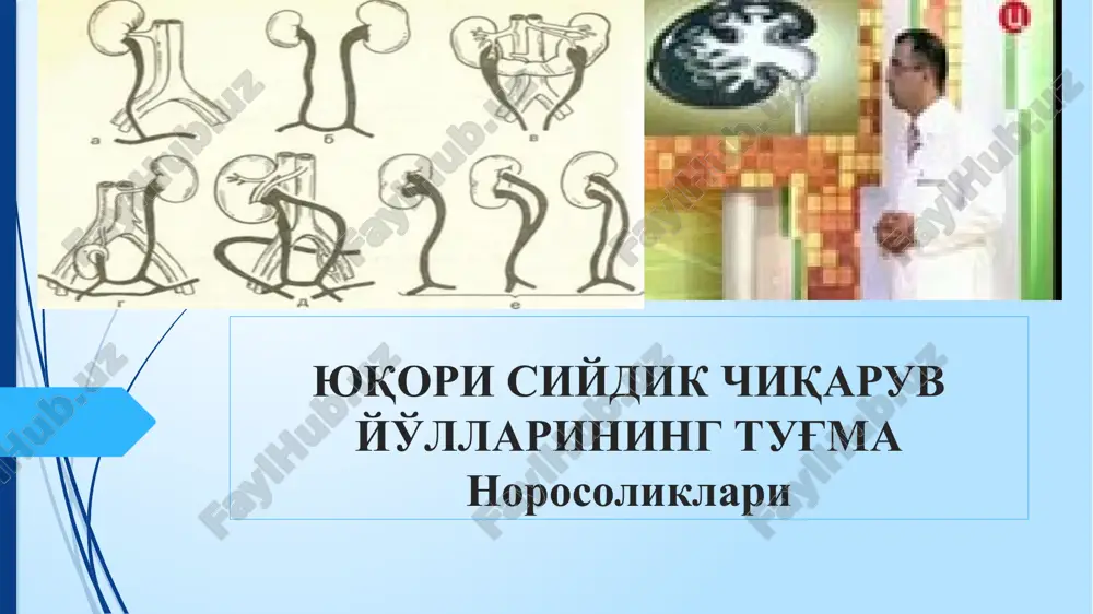 yuqori siydik chiqarish yo'llari norasoliklari — PPTX