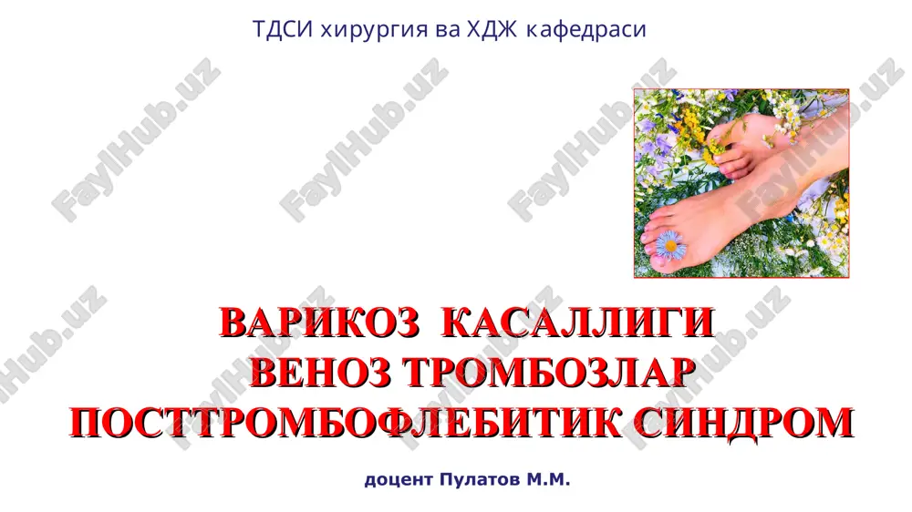 varikoz kasalligi — PPT