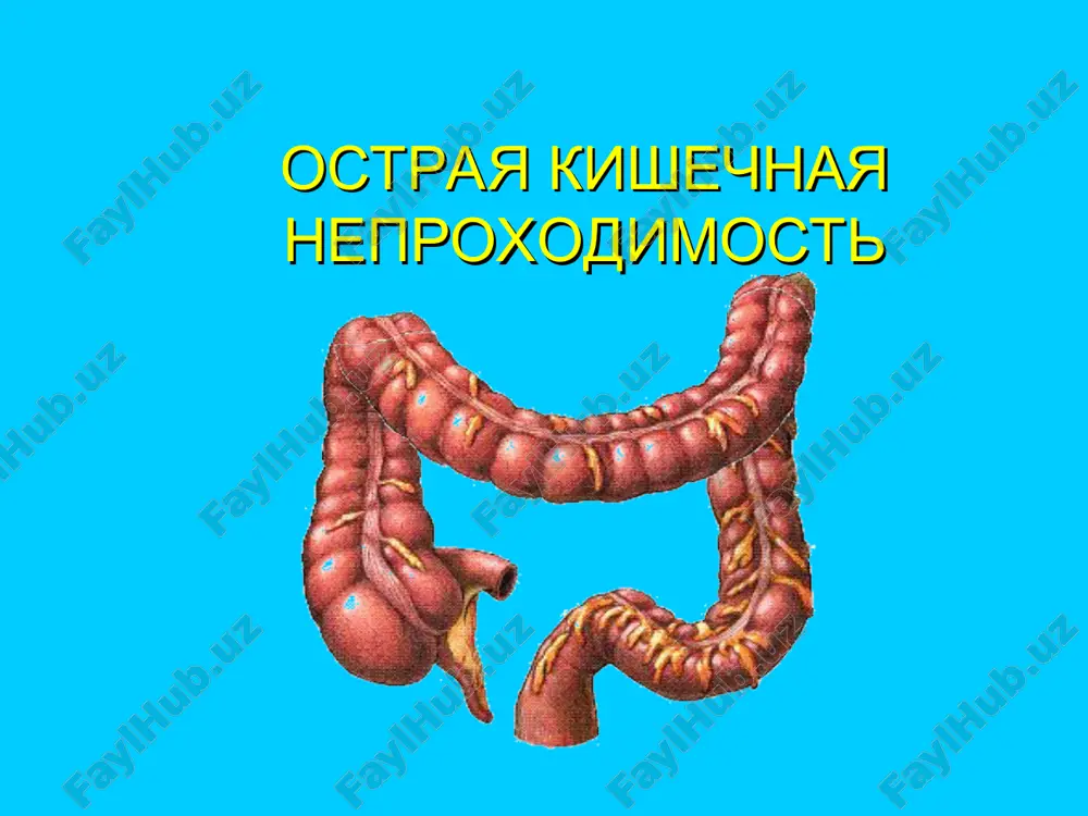 ostriy kishechnaya neproxodimost — PPT