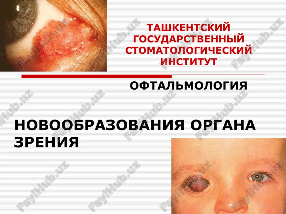 opuxoli organa zreniya — PPT