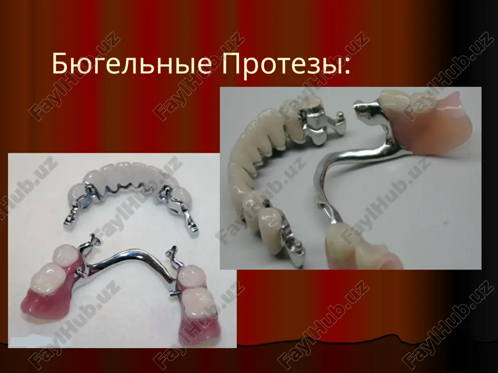 byugelnie protezi — PPTX