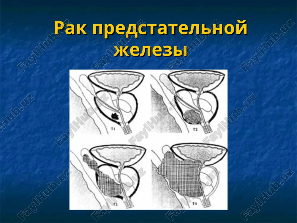 rak predstatelnoy jelezi — PPT