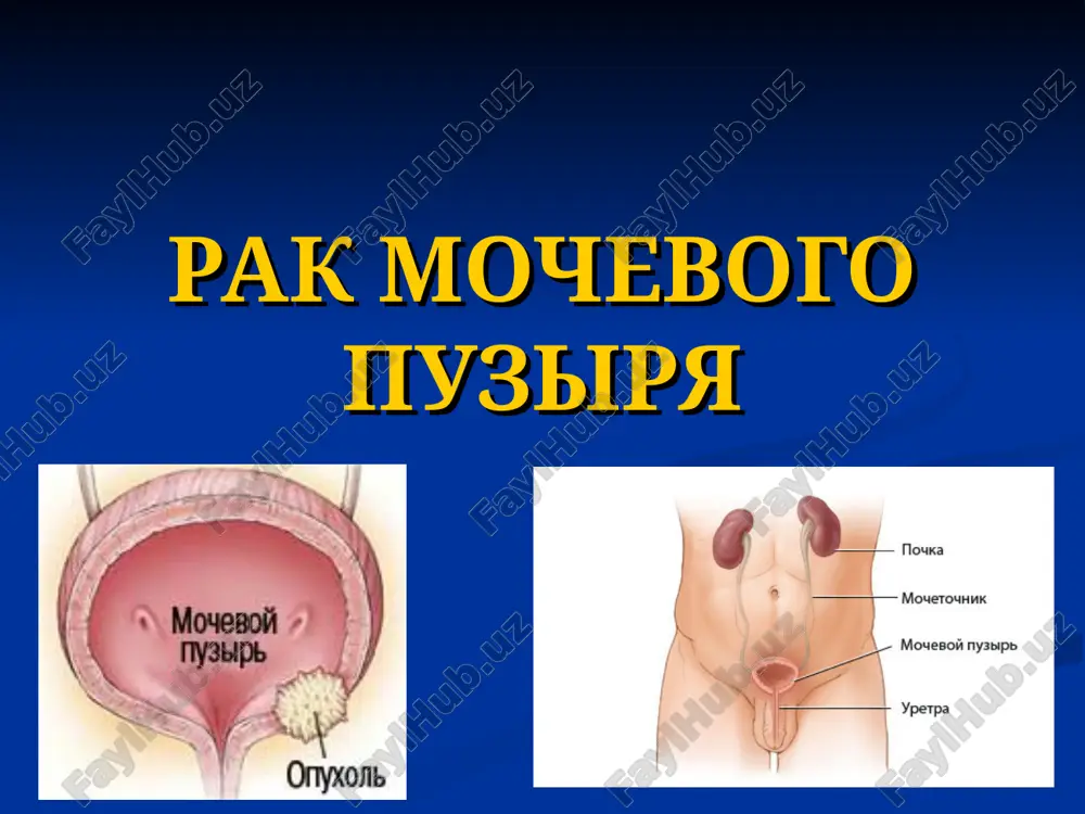 rak mochevogo puzirya — PPT