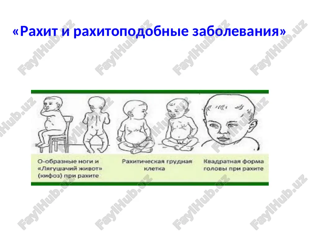 raxit i raxitopodobnie zabolevaniya — PPT
