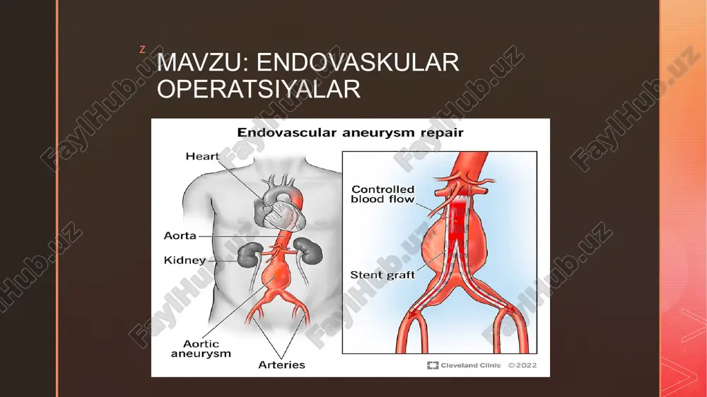 endovaskular operatsiyalar — PPTX