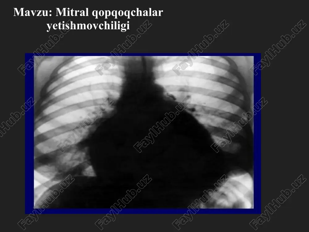mitral qopqoqchalar yetishmovchiligi — PPTX