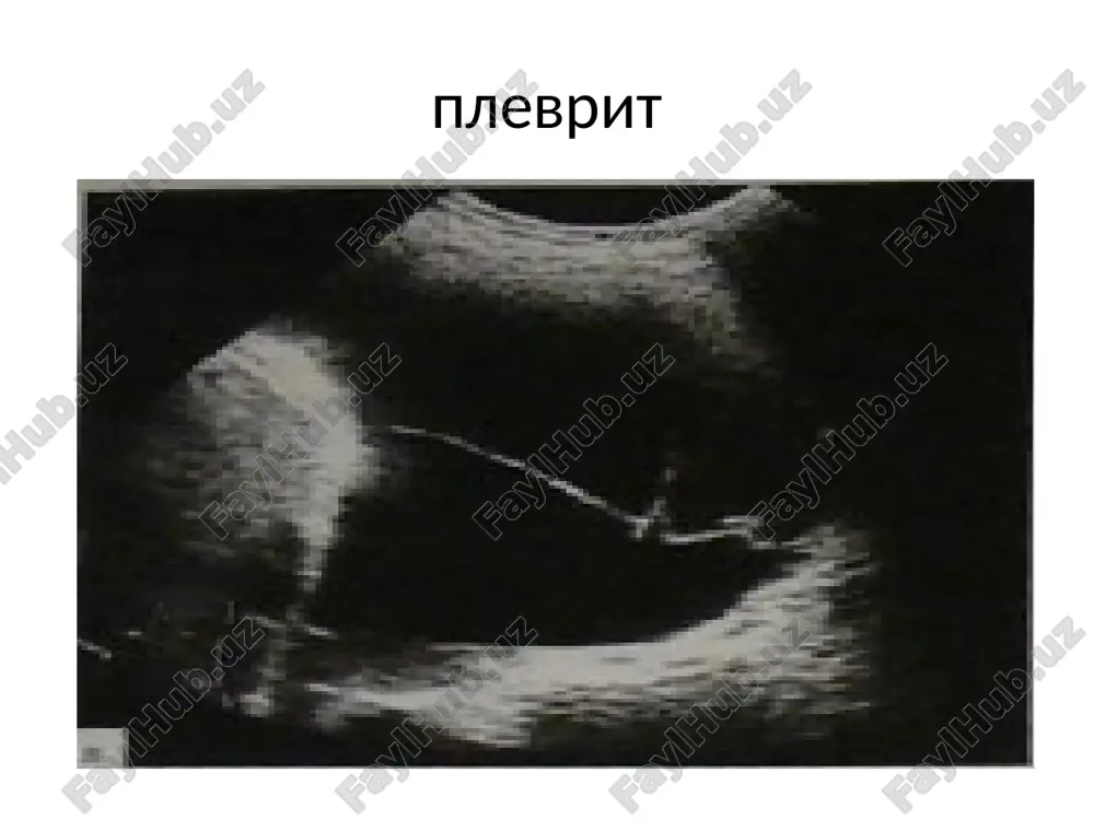 plevrit — PPTX