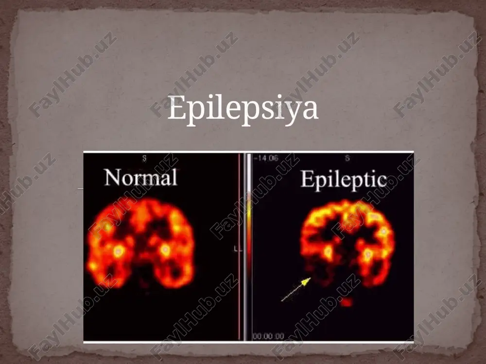 эпилепсия — ZIP