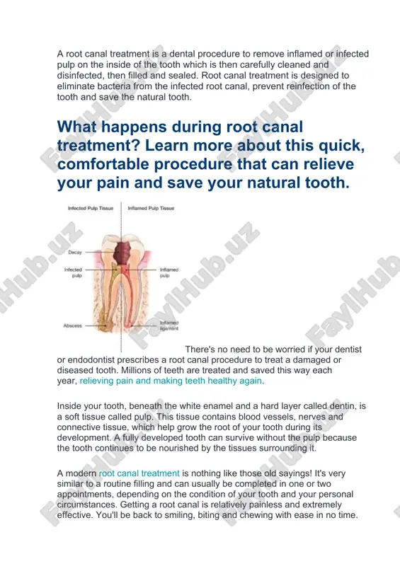 all about root canals — DOCX