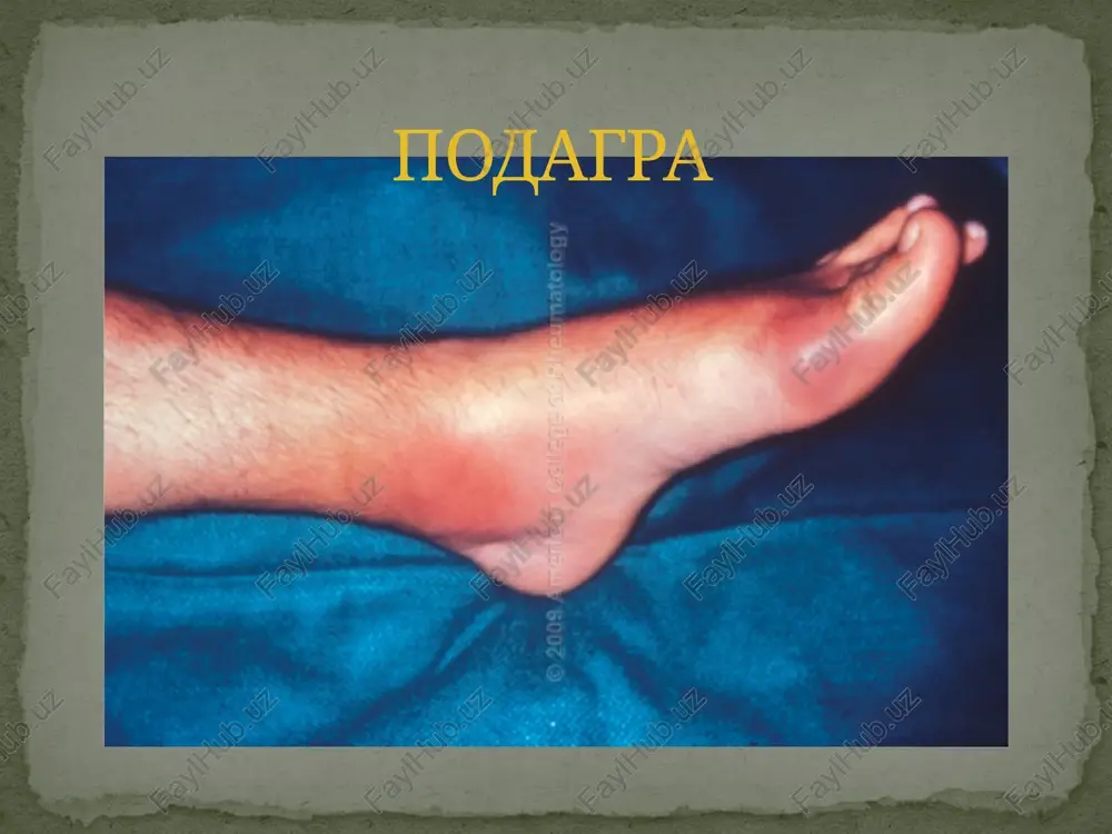 podagra — PPTX
