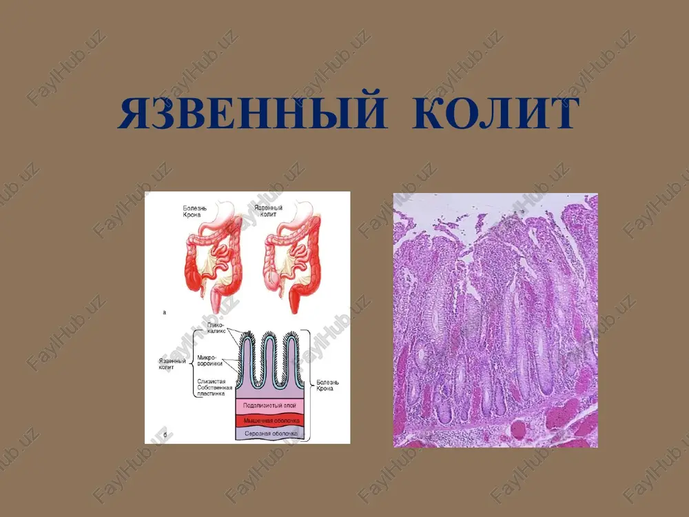 nespetsificheskiy yazvenniy kolit — PPT