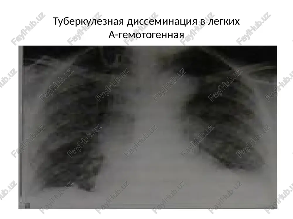 tuberkulez — PPTX