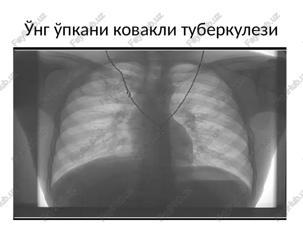 o'pkani kovakli tuberkulezi — PPTX