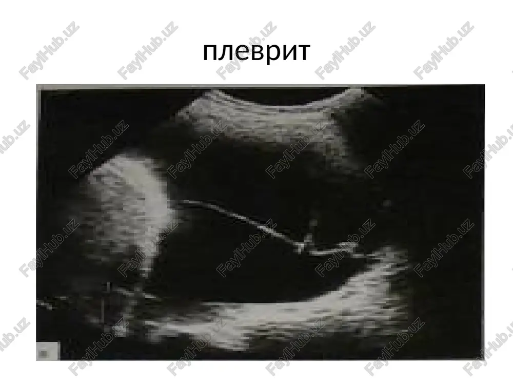 plevrit — PPTX