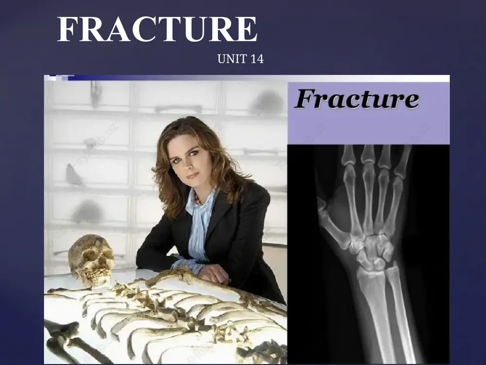 fracture — PPTX