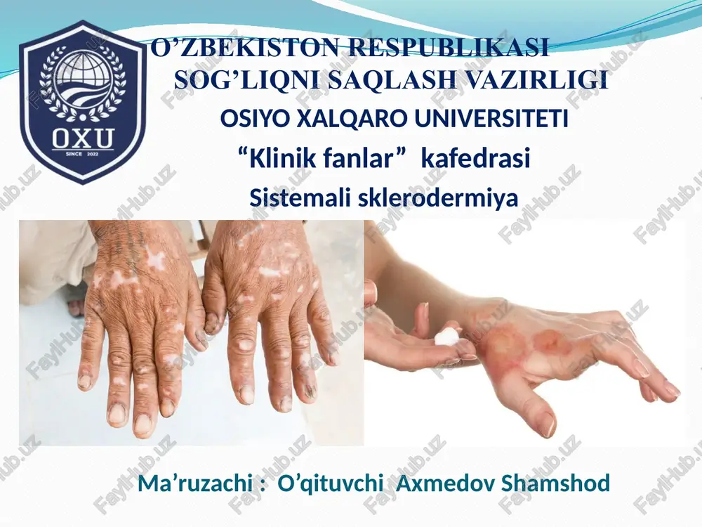 sistemalisklerodermiya — PPTX