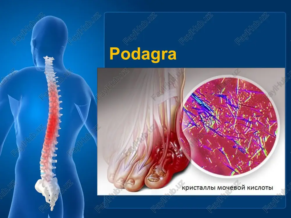 podagra — PPTX